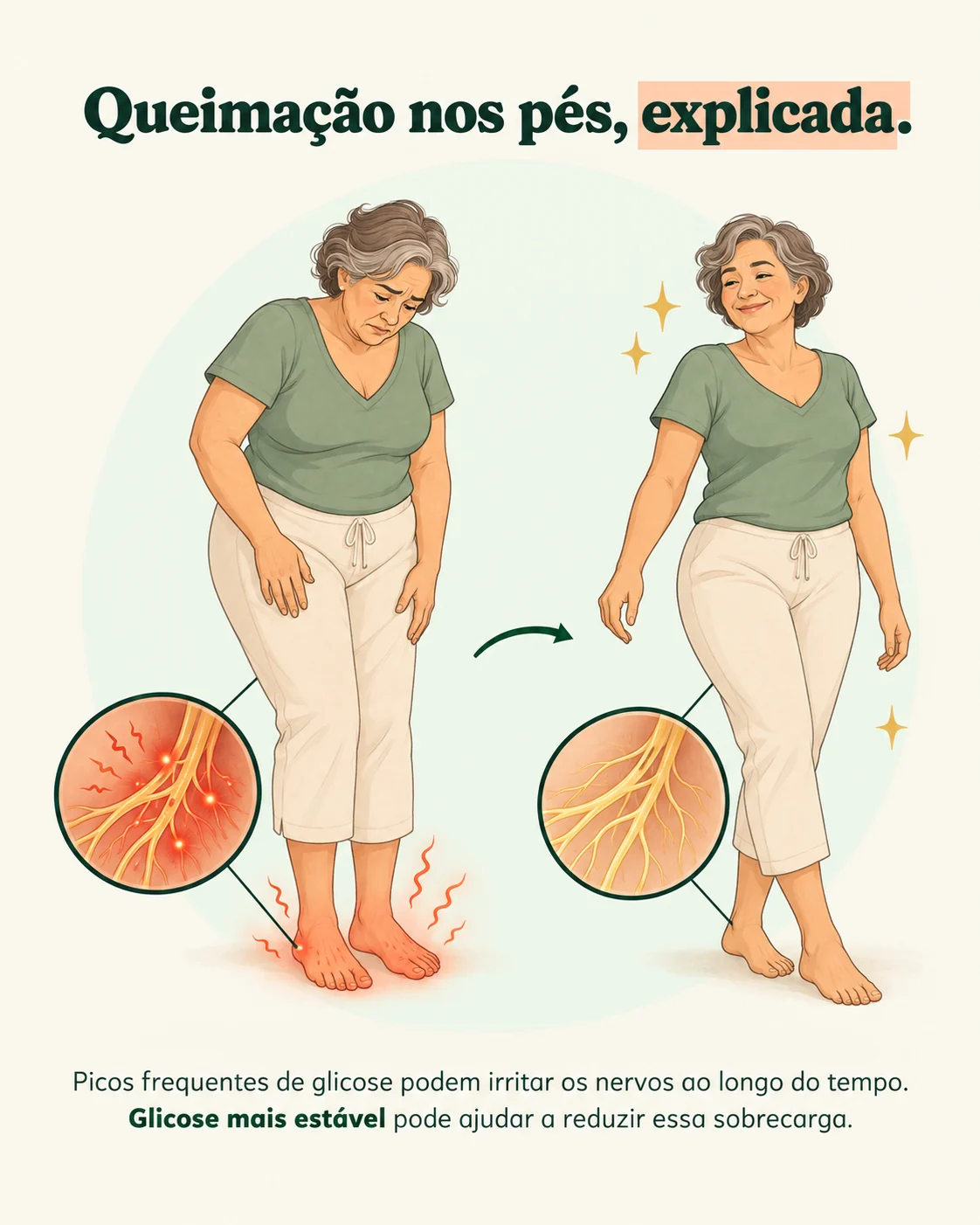 Queimação nos pés, explicada. Ilustração comparativa de uma mulher com desconforto nos pés e a mesma personagem em pé, com detalhes dos nervos.